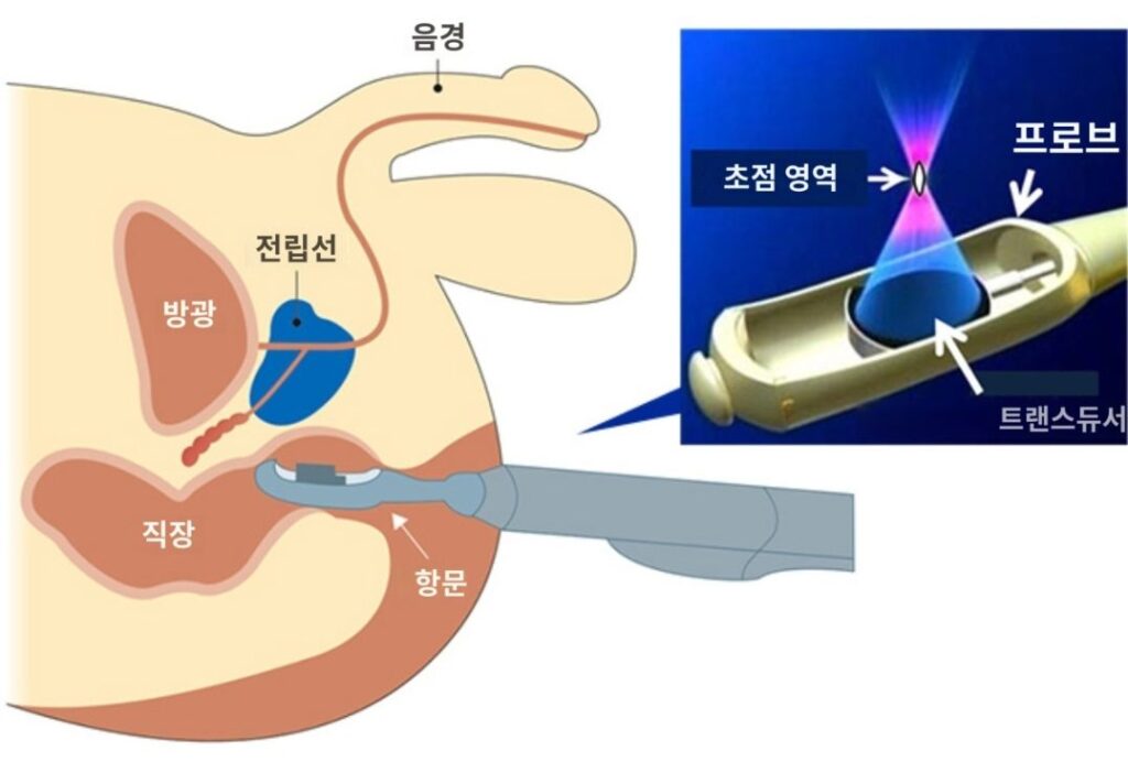 전립선암하이프치료