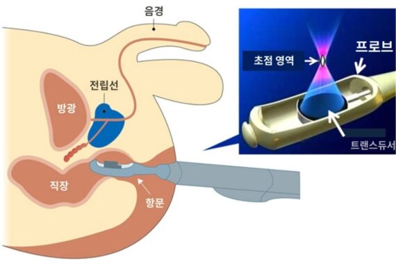 전립선암하이프치료